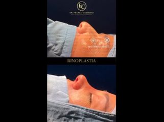 Rinoplastia - Dr. Franco Cravioto