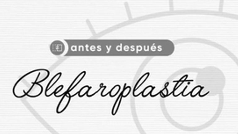 Blefaroplastia - Dr. Alejandro Méndez Sashida