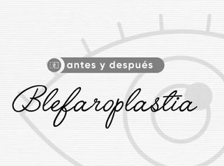 Blefaroplastia - Dr. Alejandro Méndez Sashida