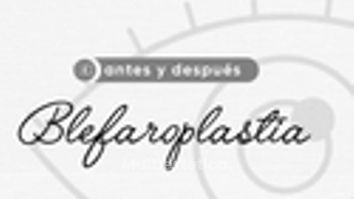 Blefaroplastia - Dr. Alejandro Méndez Sashida