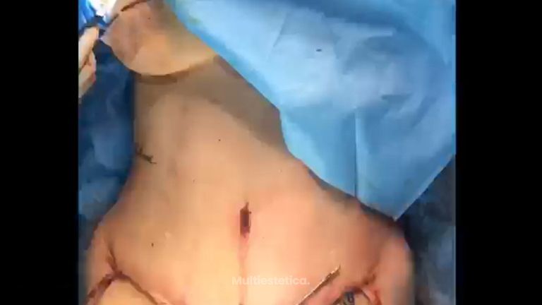 Abdominoplastia 