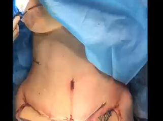 Abdominoplastia 