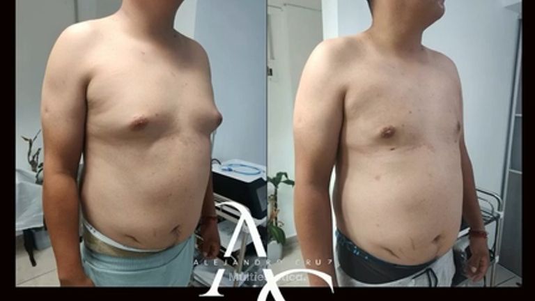 Cirugia Gincecomastia - Dr. Alejandro Cruz Segura
