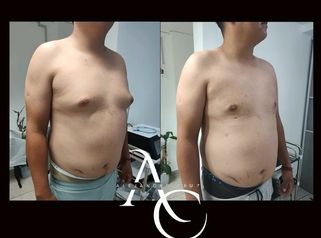 Cirugia Gincecomastia - Dr. Alejandro Cruz Segura