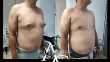 Cirugia Gincecomastia - Dr. Alejandro Cruz Segura