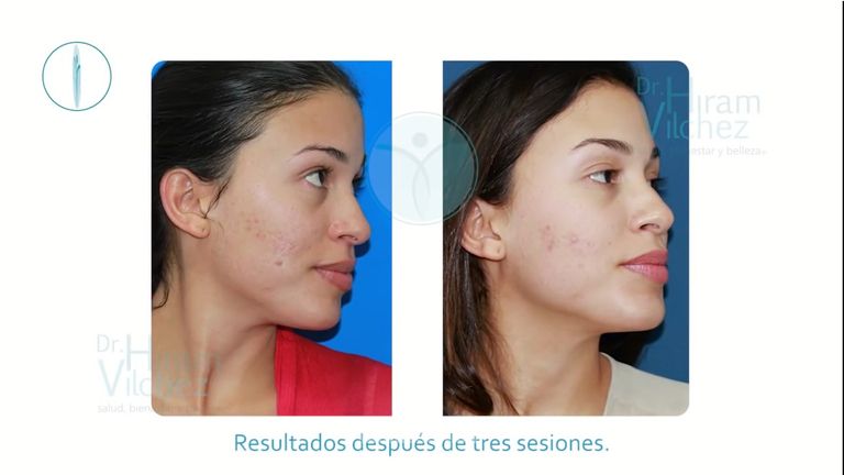 Terapia de inducción de colágeno para cicatrices de acné con nano pore turboroller