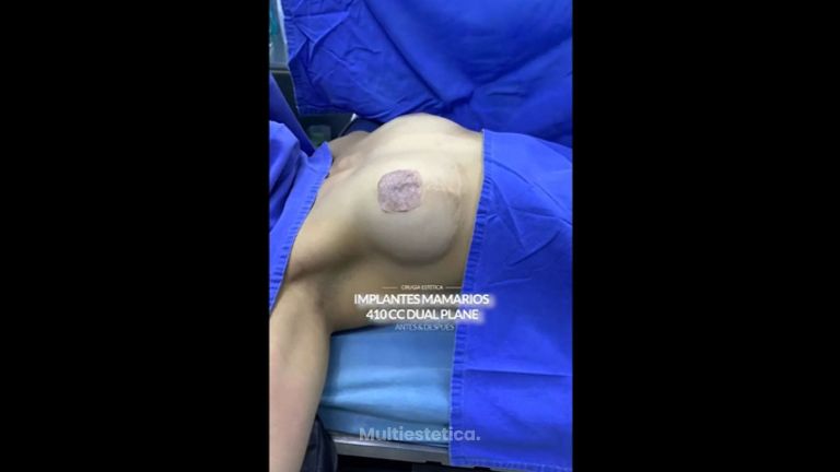 Aumento de busto - Euroderma
