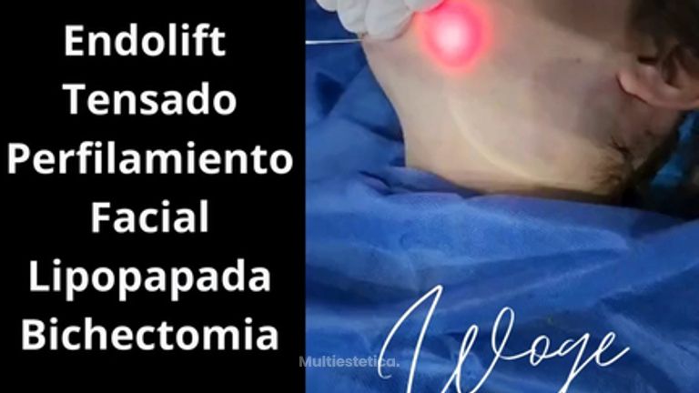 Endolift Perfilamiento Facial - Dr. Carlos Woge