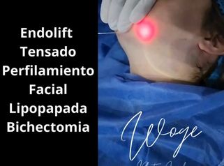 Endolift Perfilamiento Facial - Dr. Carlos Woge