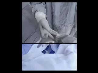 Rinoplastia - Dr. Christian Augusto Morales Orozco