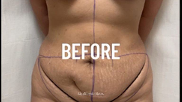 Abdominoplastia + Levantamiento Busto - Dr. Rigoberto Castellanos