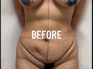 Abdominoplastia + Levantamiento Busto - Dr. Rigoberto Castellanos