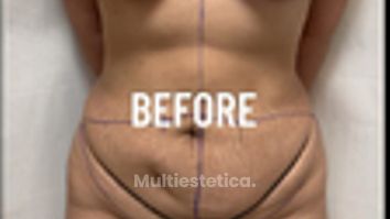 Abdominoplastia + Levantamiento Busto - Dr. Rigoberto Castellanos