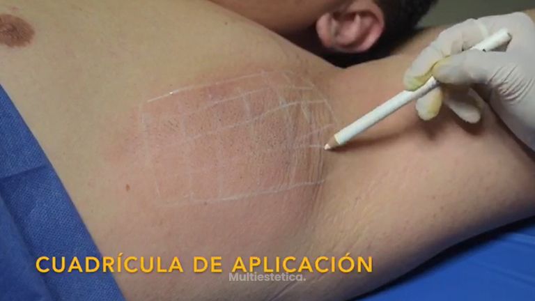 Hiperhidrosis