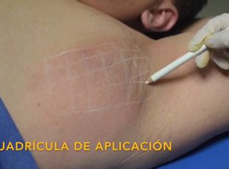 Hiperhidrosis