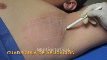 Hiperhidrosis