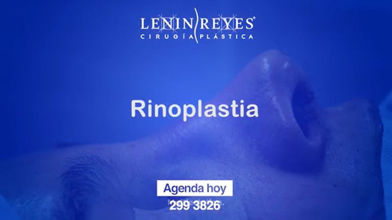 Rinoplastia