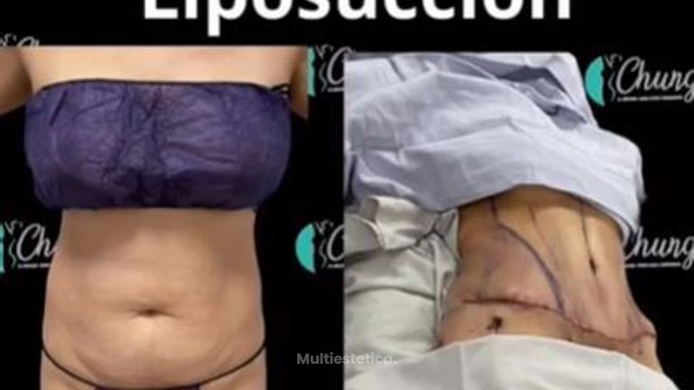 Abdominoplastia - Dr. Jesus Eduardo Chung Gallardo