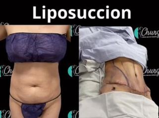 Abdominoplastia - Dr. Jesus Eduardo Chung Gallardo