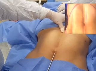 Lipoescultura HD