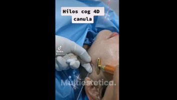 Hilos tensores - Dra. Zuleyma Lili Juarez Gutierrez