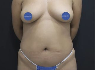 Lipoescultura - Dr. Lenin Alfonso Reyes Ibarra