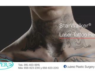 Eliminación de tatuajes - Clínica De Cirugía Plástica Lazer