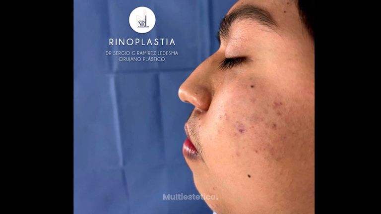 Rinoplastia - Dr Sergio Guillermo Ramírez Ledesma