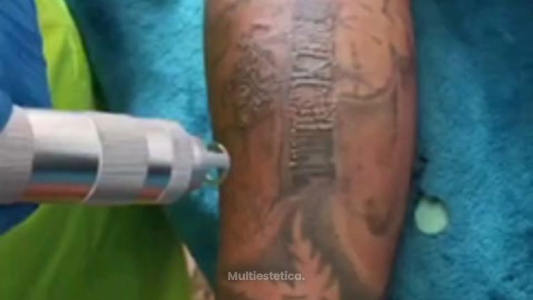 Eliminación de tatuajes - MEILi Rejuvenecimiento y Acupuntura