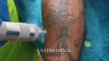 Eliminación de tatuajes - MEILi Rejuvenecimiento y Acupuntura