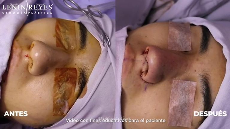 Rinoplastia con cartílago - Dr. Lenin Alfonso Reyes Ibarra