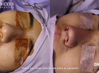 Rinoplastia con cartílago - Dr. Lenin Alfonso Reyes Ibarra