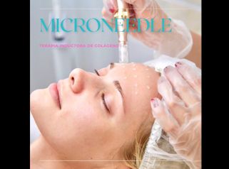 Microneedling - Clínica Heal Aesthetics