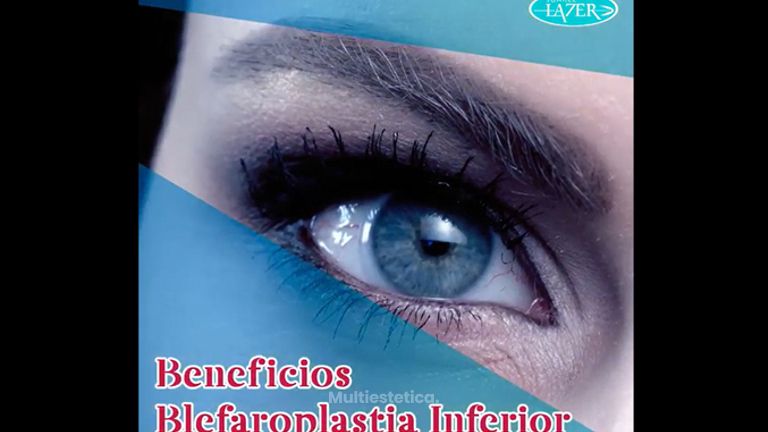 Blefaroplastia - Clínica De Cirugía Plástica Lazer