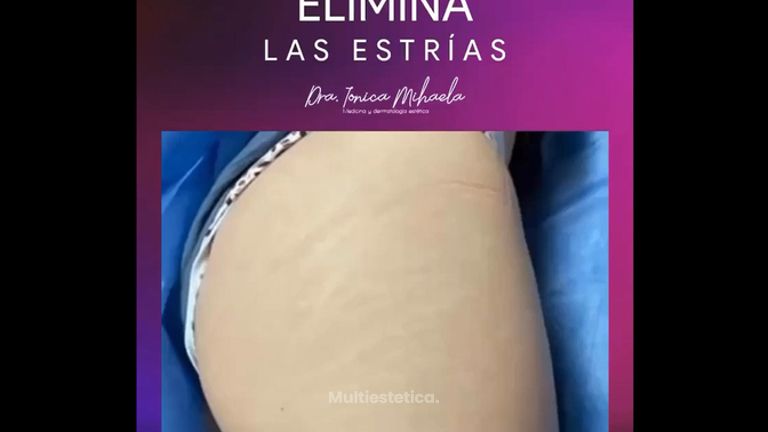 Eliminación de estrías - Dra. Ionica Mihaela Dogaru