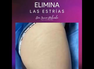 Eliminación de estrías - Dra. Ionica Mihaela Dogaru