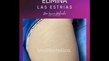 Eliminación de estrías - Dra. Ionica Mihaela Dogaru