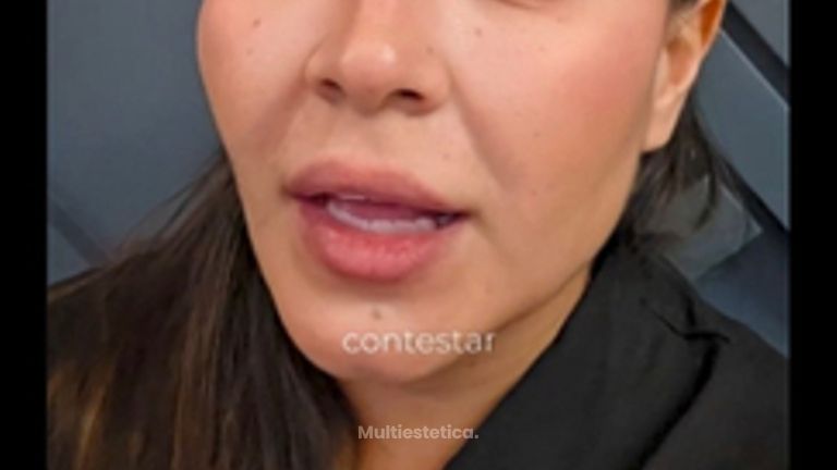 Armonizacion Facial - Dra. Lorena Piña