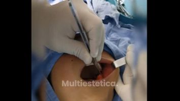 Bolsas de bichat - Clínica Denisse