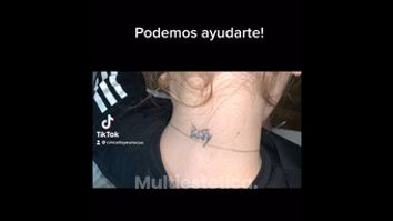 Eliminación de tatuajes - CMCells