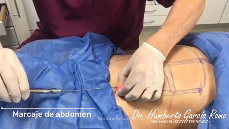Marcaje abdominal - Dr. Jorge Humberto García Romo
