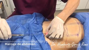 Marcaje abdominal - Dr. Jorge Humberto García Romo