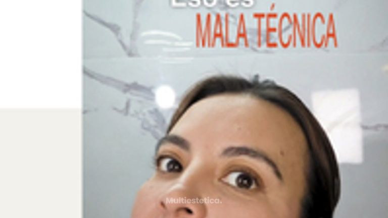 Botox - Dra. Lorena Piña