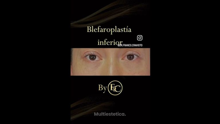 Blefaroplastia - Dr. Franco Cravioto