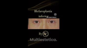 Blefaroplastia - Dr. Franco Cravioto