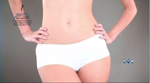 Cómo es la abdominoplastia Cómo es la abdominoplastia
