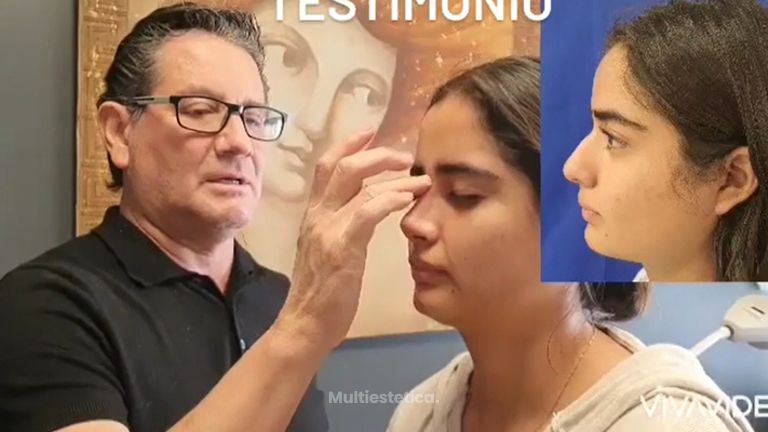 Rinoplastia - Cirugía Plástica Estética. Dr. Alfredo Meza.