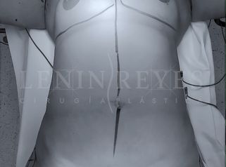 Lipoescultura - Dr. Lenin Alfonso Reyes Ibarra