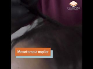 Mesoterapia capilar