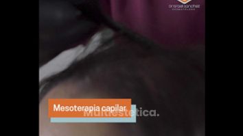 Mesoterapia capilar